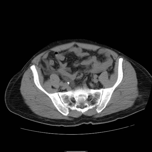 File:Obstructed kidney with perinephric urinoma (Radiopaedia 26889-27066 Axial non-contrast 51).jpg