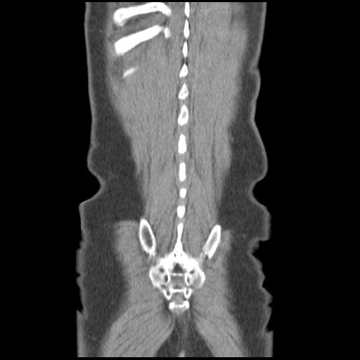 Obstructing renal calculus (Radiopaedia 29517-30016 Coronal non-contrast 49).jpg