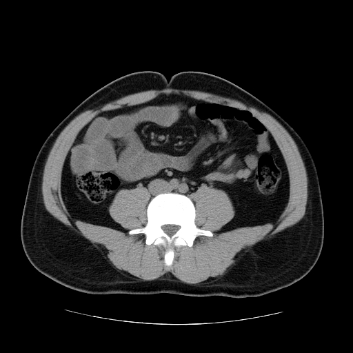 File:Obstructing ureteric calculus (Radiopaedia 18615-18514 Axial non-contrast 33).jpg
