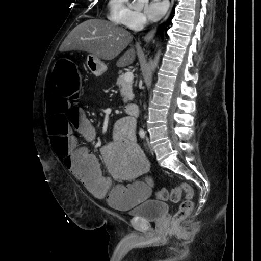 Obstructive colonic diverticular stricture (Radiopaedia 81085-94675 C 123).jpg