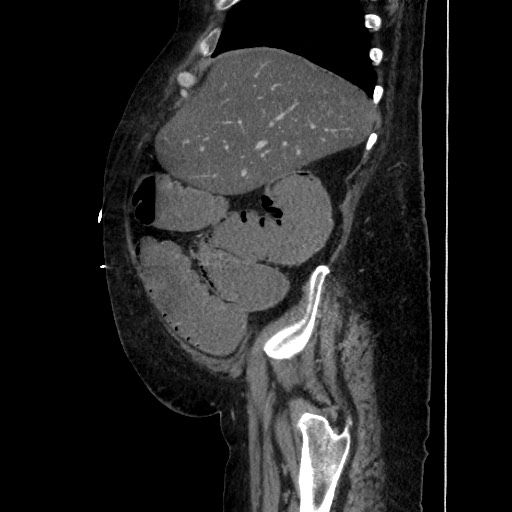 Obstructive colonic diverticular stricture (Radiopaedia 81085-94675 C 63).jpg