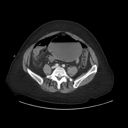 Obstructive distal colonic adenocarcinoma causing cecal perforation (Radiopaedia 86830-102989 A 133).jpg