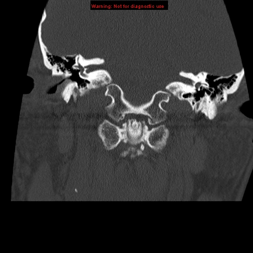 File:Occipital condyle fracture (Radiopaedia 18366-18208 Coronal bone window 6).jpg