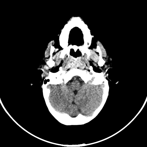 Occipital encephalocele (Radiopaedia 87339-103636 Axial non-contrast 20).jpg