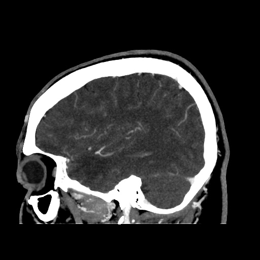 Occipital extradural hematoma simulating venous sinus thrombosis (Radiopaedia 46514-50964 D 58).jpg