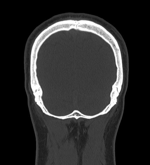 Occipital spur and Currarino type A atlas anomaly (Radiopaedia 87027-103285 Coronal bone window 123).jpg