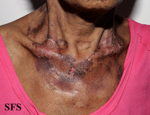 File:Pellagra (Dermatology Atlas 46).jpg