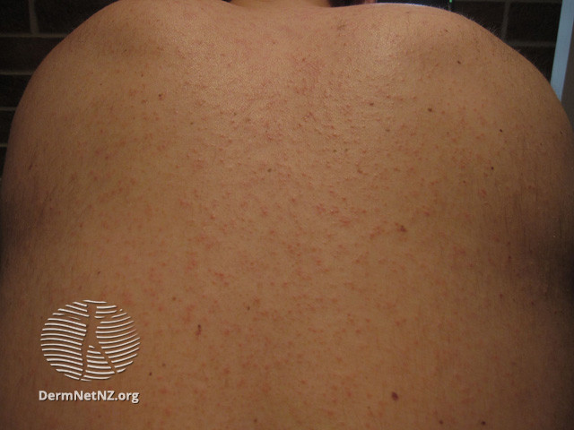 File:Rash Day 2 (DermNet NZ viral-measles04).jpg