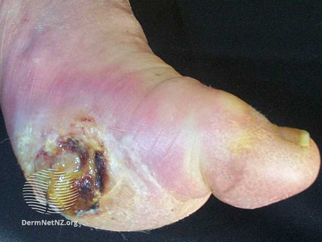 File:Ulcer due to diabetic neuropathy (DermNet NZ diab-foot1-big).jpg