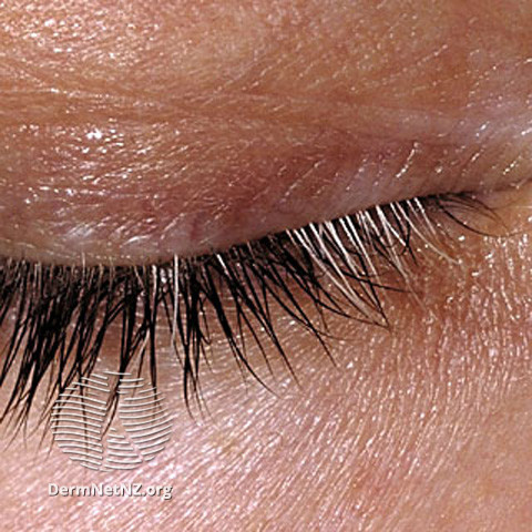 File:Vitiligo (DermNet NZ hair-nails-sweat-s-poliosis).jpg