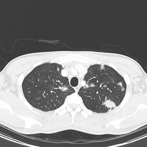AIDS-related Kaposi sarcoma (Radiopaedia 85247-100811 Axial lung window 33).jpg
