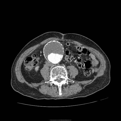 File:Abdominal aortic aneurysm (Radiopaedia 13341-13340 Axial C+ arterial phase 125).jpg