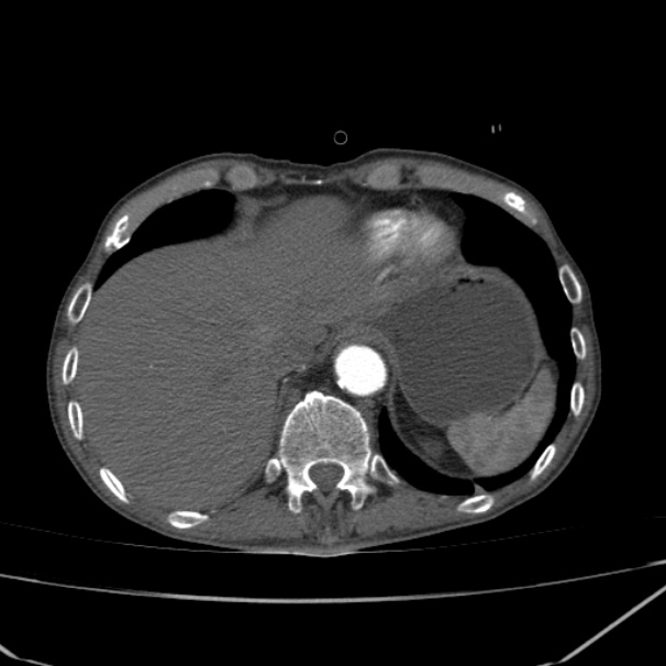 Abdominal aortic aneurysm (Radiopaedia 23703-23856 Axial C+ arterial phase 4).jpg