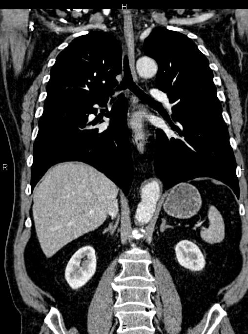 Abdominal aortic aneurysm (Radiopaedia 83094-97462 Coronal renal cortical phase 57).jpg