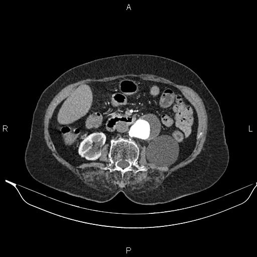 File:Abdominal aortic aneurysm (Radiopaedia 85063-100606 Axial C+ arterial phase 39).jpg