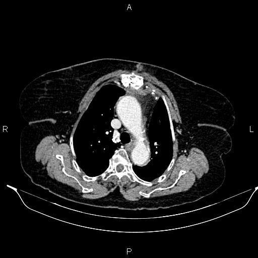 File:Abdominal aortic aneurysm (Radiopaedia 85063-100606 Axial C+ portal venous phase 13).jpg