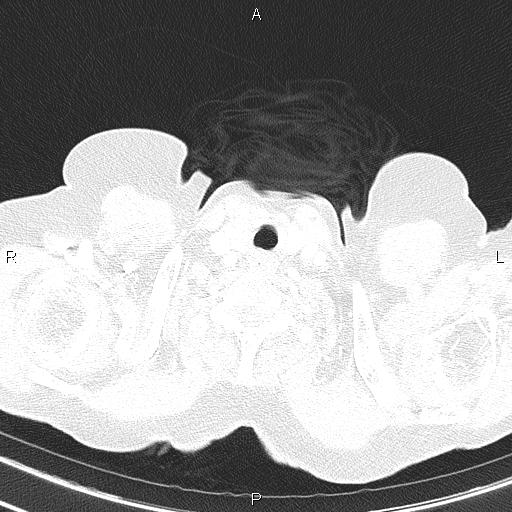 Abdominal aortic aneurysm (Radiopaedia 85063-100606 Axial lung window 6).jpg