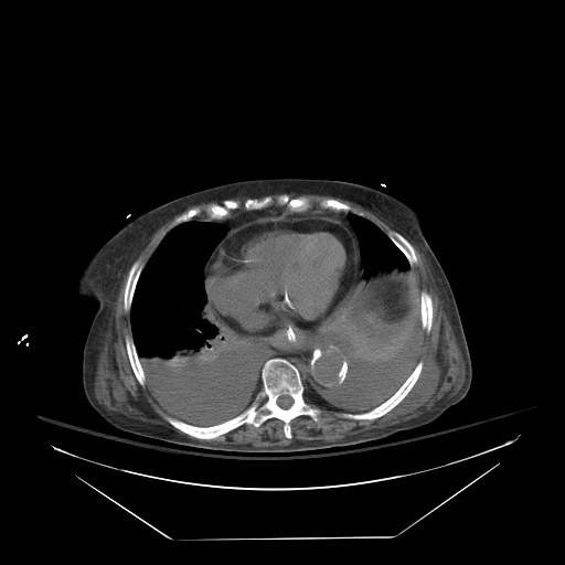 Abdominal aortic aneurysm - impending rupture (Radiopaedia 19233-19247 Axial non-contrast 22).jpg