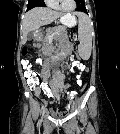 Abdominal lymphoma with sandwich sign (Radiopaedia 84378-99704 Coronal C+ portal venous phase 21).jpg
