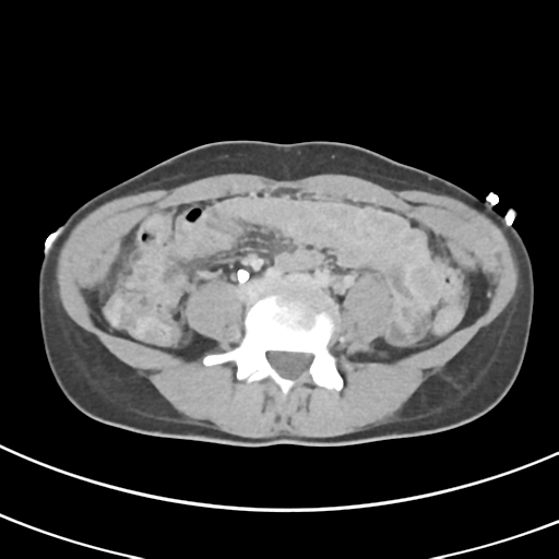 File:Abdominal multi-trauma - devascularised kidney and liver, spleen and pancreatic lacerations (Radiopaedia 34984-36486 Axial C+ delayed 50).png