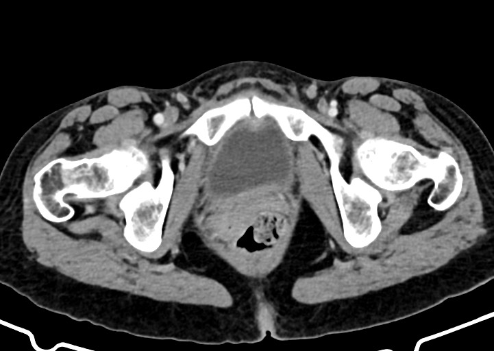 Abdominal wall and retroperitoneal tuberculosis (Radiopaedia 88137-104729 Axial C+ portal venous phase 189).jpg