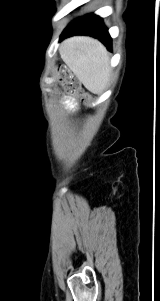 Abdominal wall and retroperitoneal tuberculosis (Radiopaedia 88137-104729 Sagittal C+ portal venous phase 18).jpg