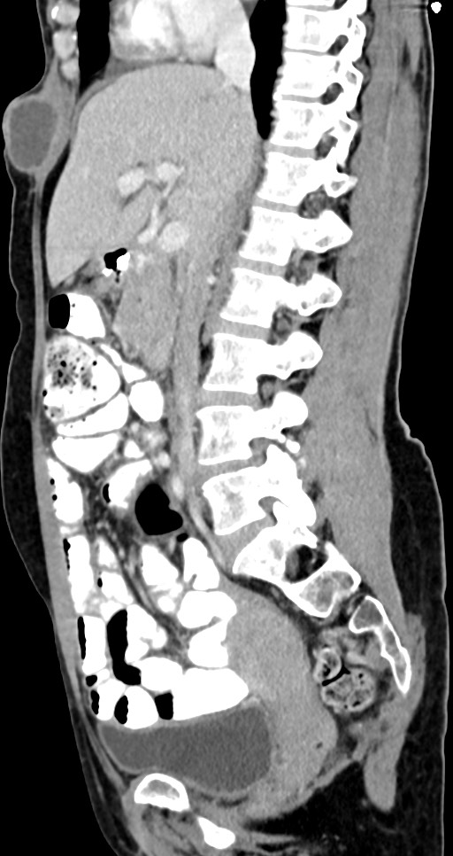 Abdominal wall and retroperitoneal tuberculosis (Radiopaedia 88137-104729 Sagittal C+ portal venous phase 86).jpg