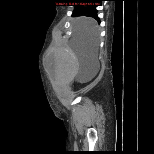 Abdominal wall hematoma (Radiopaedia 9427-10112 Sagittal C+ portal venous phase 95).jpg