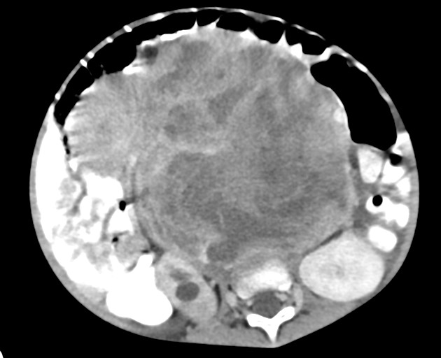 Abdominopelvic rhabdomyosarcoma (Radiopaedia 78356-90984 Axial C+ portal venous phase 94).jpg