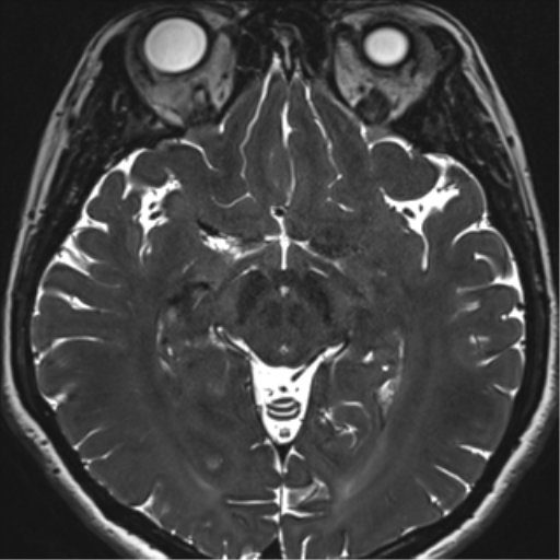 File:Abducens nerve palsy (Radiopaedia 51069-56648 Axial T2 fat sat 77).png