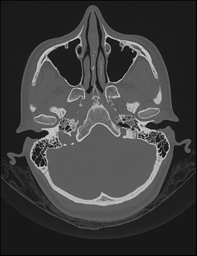 Aberrant right internal carotid artery (Radiopaedia 65191-74198 Axial non-contrast 31).jpg