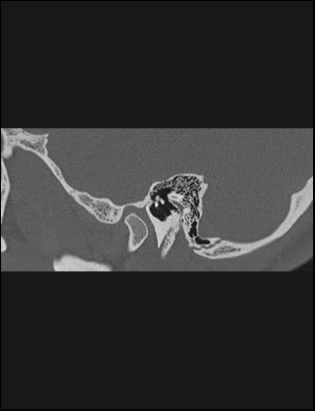 Aberrant right internal carotid artery (Radiopaedia 65191-74198 Sagittal non-contrast 42).jpg