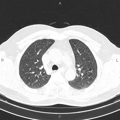 Aberrant right subclavian artery (Radiopaedia 87093-103354 Axial lung window 37).jpg