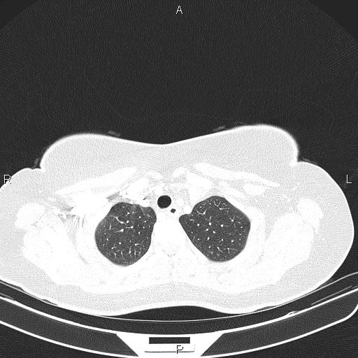 Aberrant right subclavian artery (Radiopaedia 87334-103629 Axial lung window 14).jpg