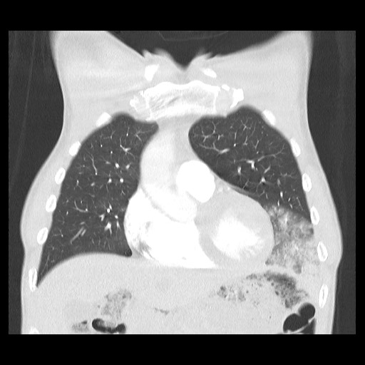 Accessory left horizontal fissure with lingular pneumonia (Radiopaedia 53763-59843 Coronal lung window 14).jpg