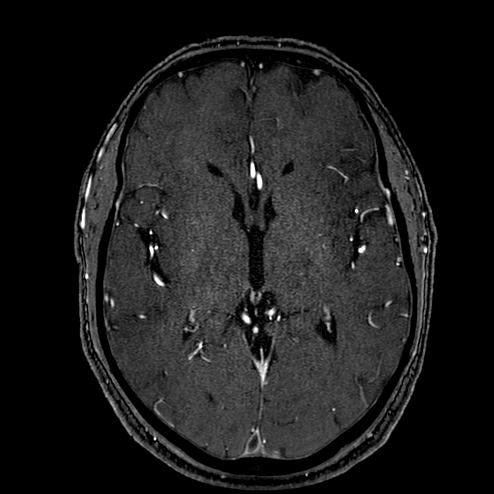 Accessory middle cerebral artery (Radiopaedia 73114-83828 Axial MRA 102).jpg