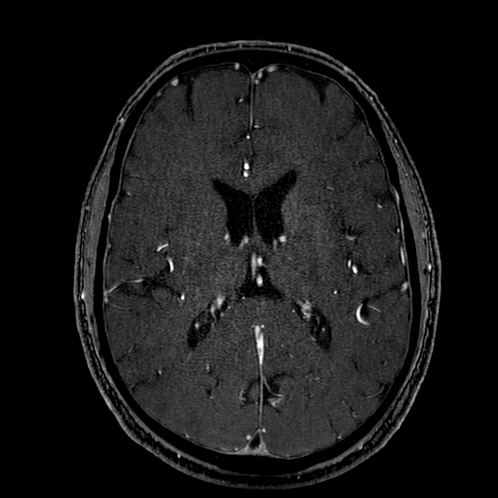 Accessory middle cerebral artery (Radiopaedia 73114-83828 Axial MRA 121).jpg