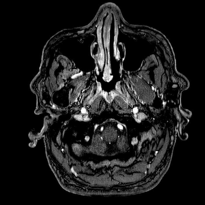 Accessory middle cerebral artery (Radiopaedia 73114-83828 Axial MRA 3).jpg