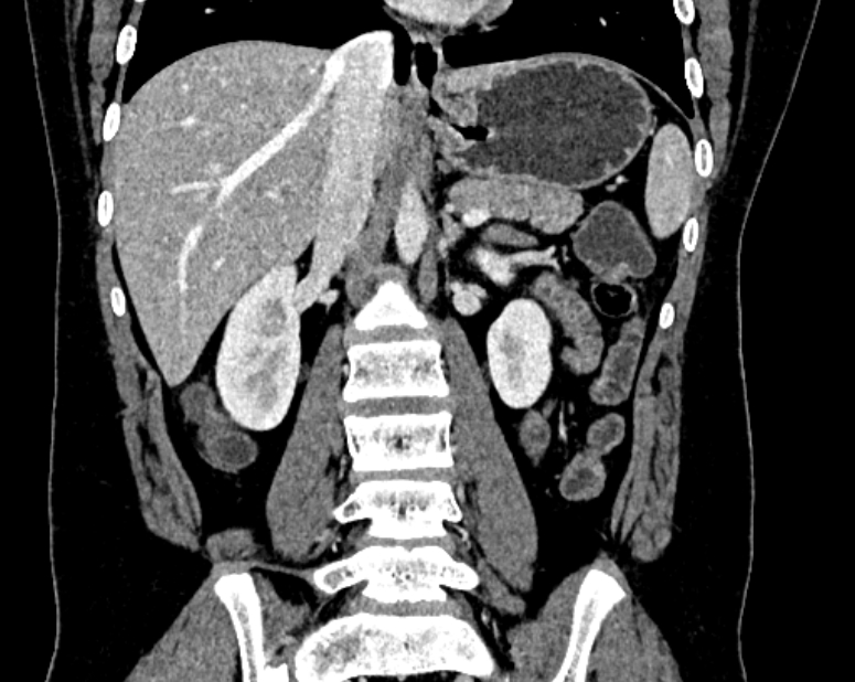 Accessory right inferior hepatic vein (Radiopaedia 75207-86305 Coronal C+ portal venous phase 37).jpg