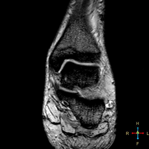 File:Achilles tendon complete tear (Radiopaedia 22834-22854 T2 fat sat 5).jpg