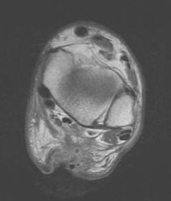 File:Achilles tendon rupture (Radiopaedia 11159-11524 D 1) (cropped).jpg