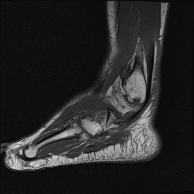 File:Achilles tendon tear (Radiopaedia 77615-89819 Sagittal T1 19).jpg