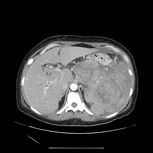 File:Acinar cell carcinoma of the pancreas (Radiopaedia 75442-86669 Axial C+ portal venous phase 35).jpg