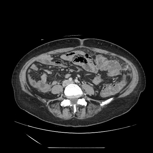Acinar cell carcinoma of the pancreas (Radiopaedia 75442-86669 Axial C+ portal venous phase 92).jpg