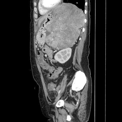 Acinar cell carcinoma of the pancreas (Radiopaedia 75442-86669 Sagittal C+ portal venous phase 130).jpg