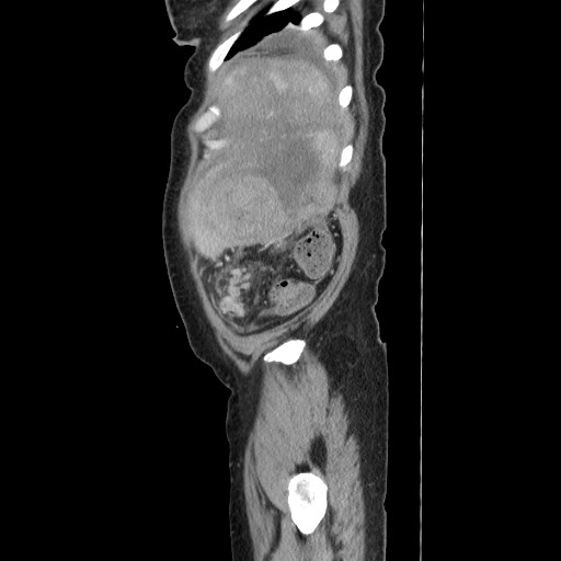 Acinar cell carcinoma of the pancreas (Radiopaedia 75442-86669 Sagittal C+ portal venous phase 170).jpg