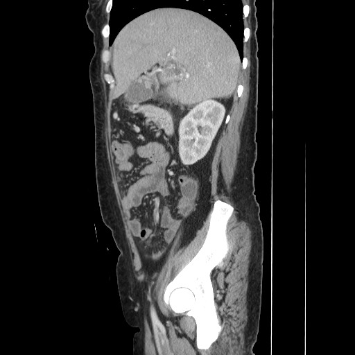 File:Acinar cell carcinoma of the pancreas (Radiopaedia 75442-86669 Sagittal C+ portal venous phase 63).jpg