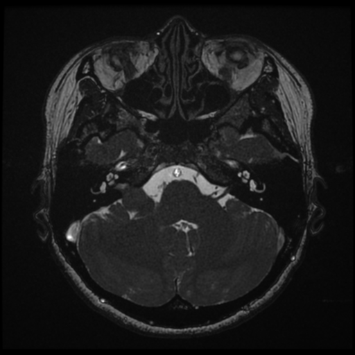 Acoustic neuroma (Radiopaedia 34049-35283 Axial 48).png