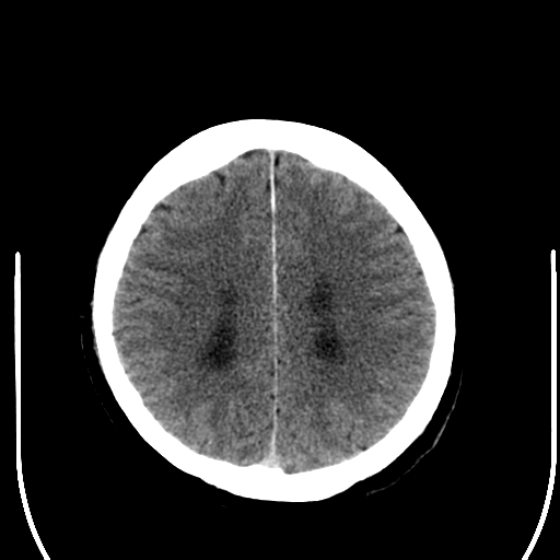 File:Acoustic schwannoma (Radiopaedia 39170-41389 Axial non-contrast 21).png