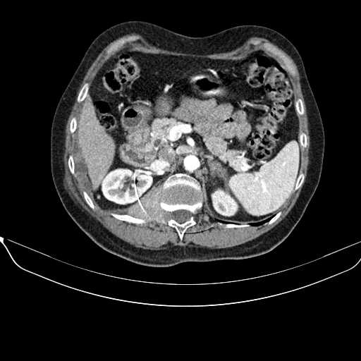 File:Acquired adrenal hyperplasia - due to thymic carcinoid tumor (Radiopaedia 21269-21184 C+ arterial phase 38).jpg